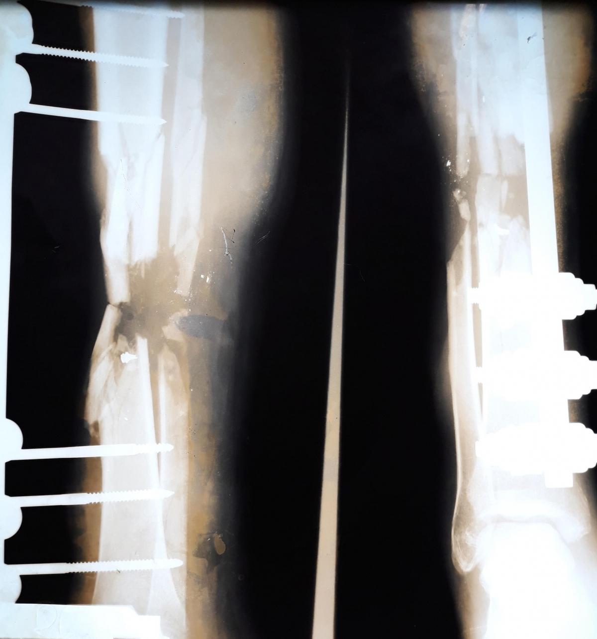 Radiographie des jambes d'Eyad, un&nbsp;Palestinien de 22 ans. La fracture de l'os de sa jambe droite nécessite de nombreuses opérations chirurgicales.
 © Alva Simpson White/MSF