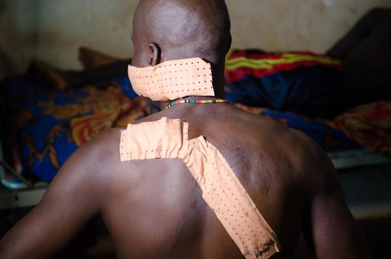 Dieudonné R.vivait à Gambo lorsque le conflit à éclaté. Il à été attaqué à la machette par des combattants.
 © Natacha Buhler/MSF