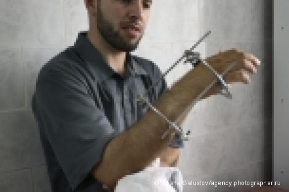 Patient opéré dans le cadre du programme de chirurgie reconstructive de l'hôpital N°9 de Grozny - Juillet 2006