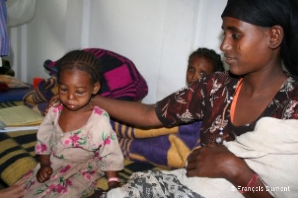 A quatre ans, le corps et le visage de Sheleme sont déformés par la malnutrition
