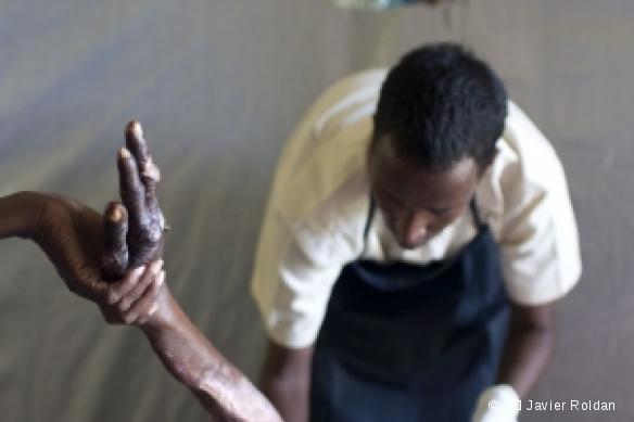 Hôpital MSF de Jamaame, juillet 2009.