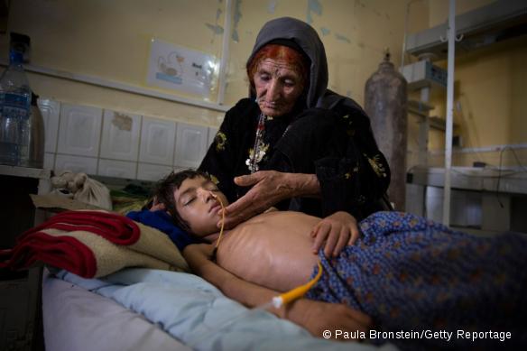 Malnutrition en Afghanistan