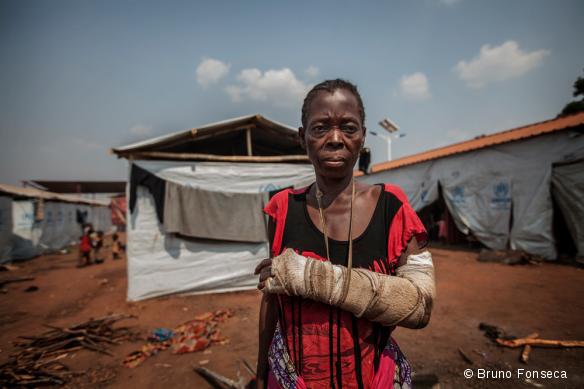 Une femme réfugiée dans le camp de Cacanda, en Angola, en juillet 2017. Elle a été blessée lors de combats dans la région du Kasaï, en RDC.