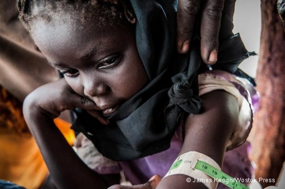 Mesure du périmètre bracchial (MUAC) pour évaluer le degré de malnutrition d'un enfant, dans le camp de Yida.