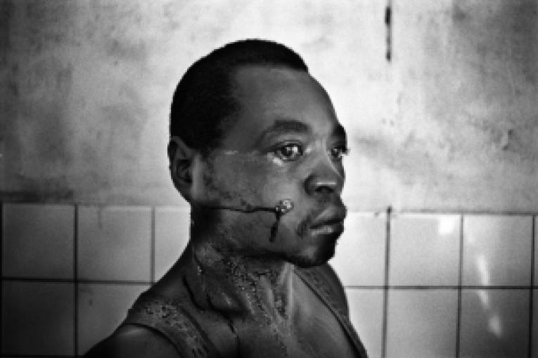 Un blessé dans l'hôpital de Masisi Nord Kivu République démocratique du Congo décembre 2007