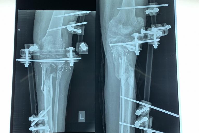Une radio de Yousri*, un patient pris en charge par MSF, montre un trou dans un os et les fixateurs externes qui soutiennent sa jambe. Il a été blessé en juillet 2018. Gaza. 2019. 