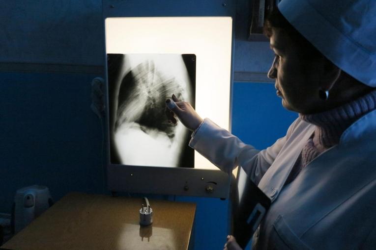 Une infirmière du ministère de la Santé inspecte la radiographie des poumons d'un patient pris en charge par MSF, au dispensaire antituberculeux d'Artyomovsk, près de Donetsk en Ukraine.