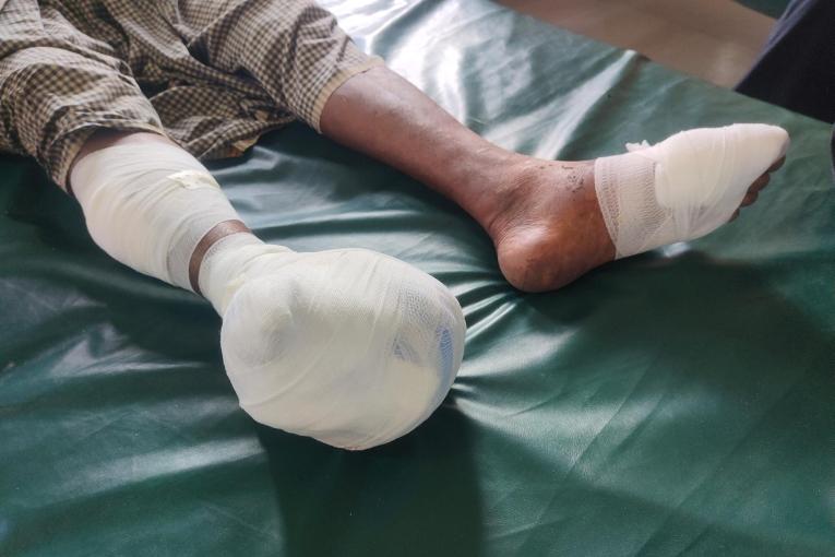 Un Rohingya a perdu sa jambe dans une explosion alors qu'il entrait au Bangladesh. En raison de la gravité de ses blessures, il est admis dans la structure de MSF à Ukhiya, où le personnel de MSF lui prodigue des soins.
