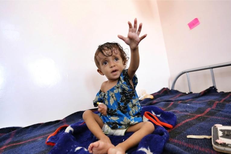 Un enfant atteint de malnutrition sévère admis à l'hôpital Al Naser du gouvernorat d'Al Dhale dans le sud du Yémen.