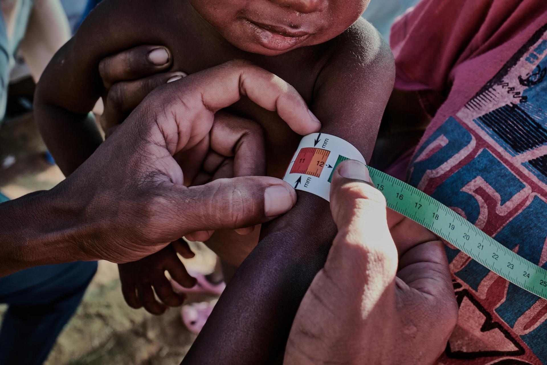 Mesure du périmètre brachial d’un jeune enfant souffrant de malnutrition aiguë sévère dans la commune de Ranobe, district d’Amboasary, à Madagascar. Dans le sud-est du pays, la population fait face à une crise alimentaire et nutritionnelle sans précédent. 
