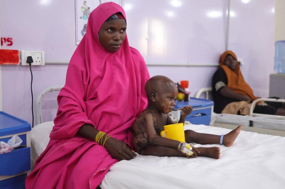 Une mère accompagne son enfant atteint de kwashiorkor dans l'unité de soins spécialisée de Katsina. L'enfant présente des gonflements et des lésions cutanées.