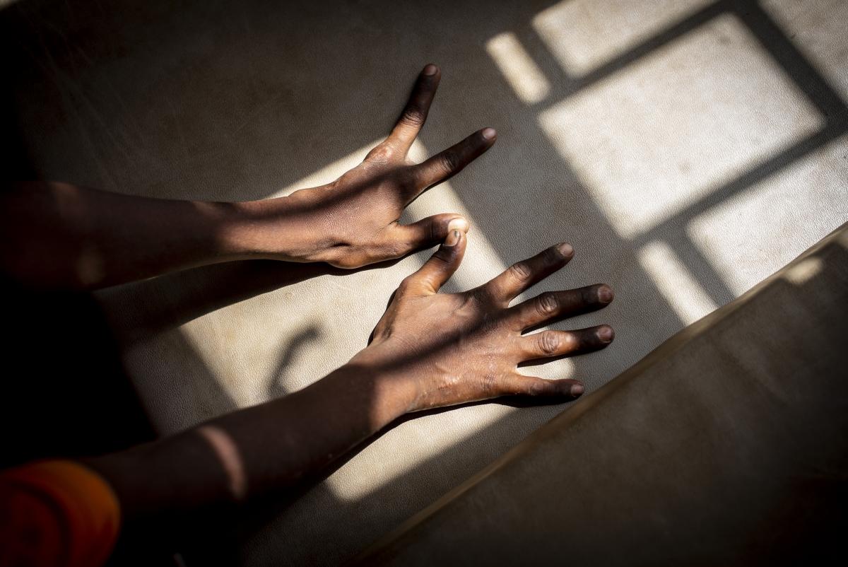 Yémen, novembre 2018. Hôpital MSF de Mocha. Les mains de Said Abdallah. L'homme a manipulé un objet explosif trouvé dans un champ.
 © Guillaume Binet / MYOP