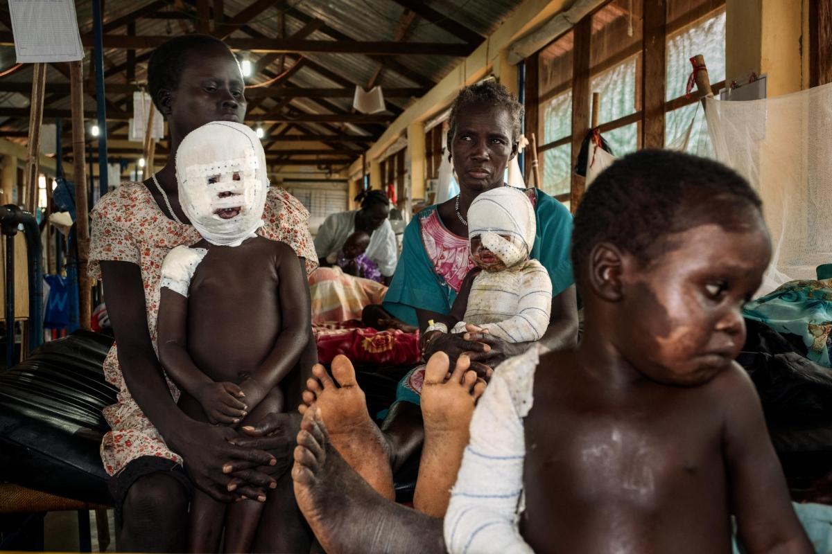Ces trois enfants jouaient&nbsp;près du feu alors que de l'eau bouillait. Ils ont été brûlés. Hôpital d'Aweil. 2017. Soudan du Sud.&nbsp;
 © Peter Bauza