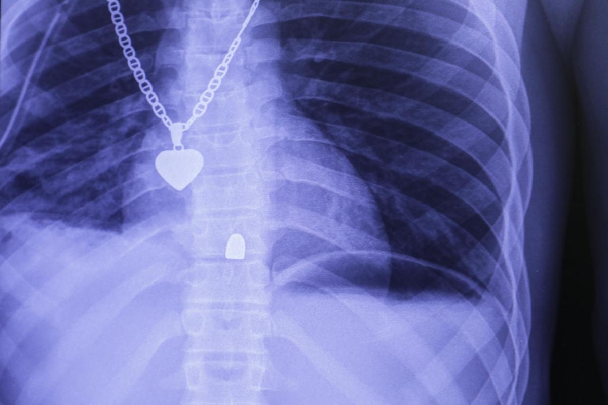 Radiographie du thorax d'un patient victime d'un tir de pistolet. La balle s'est logée dans la colonne vertébrale.&nbsp;L'opération qu'il a subie a permise de vérifier l'absence de lésions des organes internes.
 © Nicolas Guyonnet/MSF