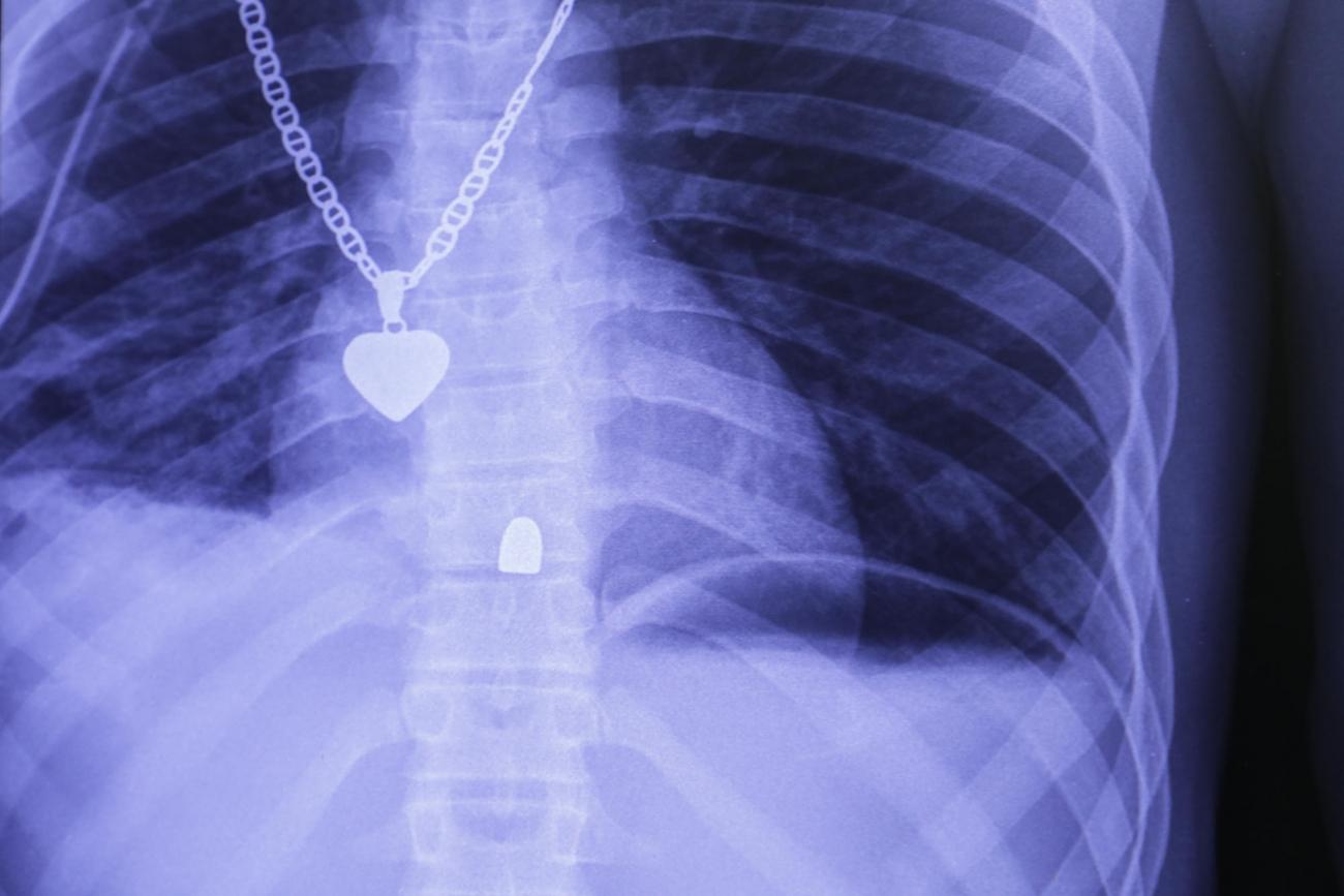 Radiographie du thorax d'un patient victime d'un tir de pistolet. La balle s'est logée dans la colonne vertébrale. L'opération qu'il a subie a permise de vérifier l'absence de lésions des organes internes.
© Nicolas Guyonnet/MSF