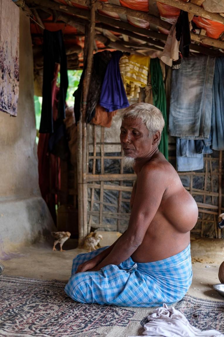 Homme de 61 ans originaire de&nbsp;Buthidaung présentant une importante protubérance de tissus mous dans le dos et sur&nbsp;la gorge.
 © Antonio Faccilongo