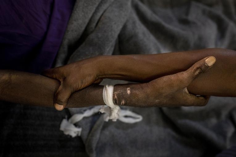 Un patient hospitalisé à l'hôpital Kabinda de Kinshasa. Il a dû être de nouveau hospitalisé, en urgence, quelques semaines seulement après sa sortie. République démocratique du Congo.
© Pablo Garrigos/MSF