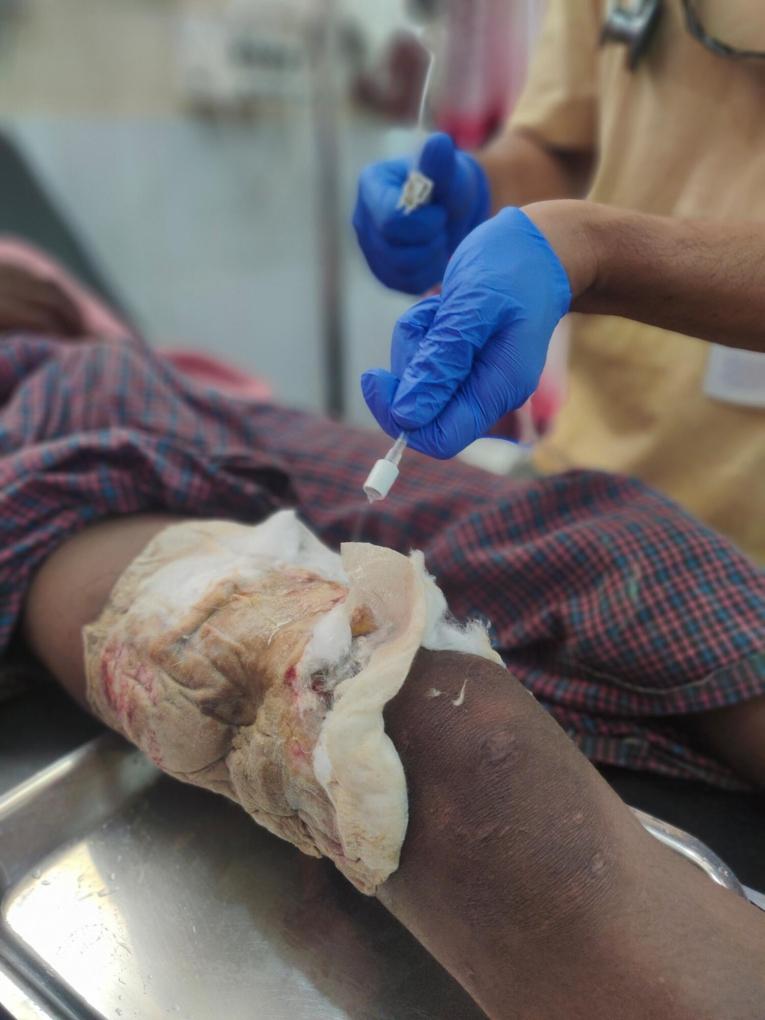Un adolescent rohingya est arrivé à l'hôpital MSF avec une grave blessure à la jambe en provenance du Myanmar. Le personnel de MSF nettoie la zone de la blessure.
© MSF