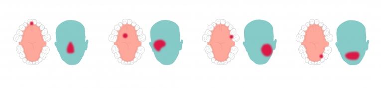 Zones d'infection et de destruction des tissus ou des os.