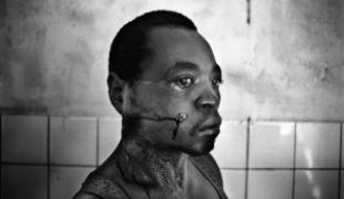 Un blessé dans l'hôpital de Masisi Nord Kivu  République démocratique du Congo décembre 2007