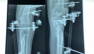 Une radio de Yousri*, un patient pris en charge par MSF, montre un trou dans un os et les fixateurs externes qui soutiennent sa jambe. Il a été blessé en juillet 2018. Gaza. 2019. 