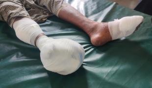Un Rohingya a perdu sa jambe dans une explosion alors qu'il entrait au Bangladesh. En raison de la gravité de ses blessures, il est admis dans la structure de MSF à Ukhiya, où le personnel de MSF lui prodigue des soins.