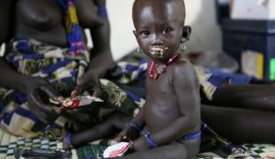 Une fillette souffrant de malnutrition est prise en charge dans le centre de santé de Pibor novembre 2007.