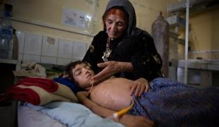 Malnutrition en Afghanistan