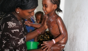 Sheleme centre de renutrition thérapeutique MSF sud de l'Ethiopie