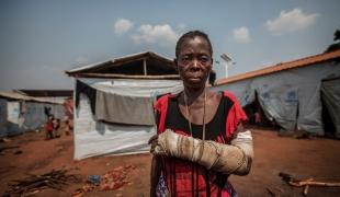 Une femme réfugiée dans le camp de Cacanda en Angola en juillet 2017. Elle a été blessée lors de combats dans la région du Kasaï en RDC.