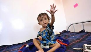 Un enfant atteint de malnutrition sévère admis à l'hôpital Al Naser du gouvernorat d'Al Dhale dans le sud du Yémen.