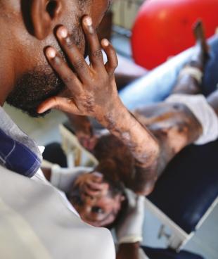 Médecins Sans Frontières offre une prise en charge spécialisée aux grands brûlés à Port-au-Prince, à Haïti.