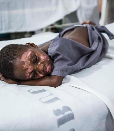 Severe burn victims in MSF Drouillard hospital