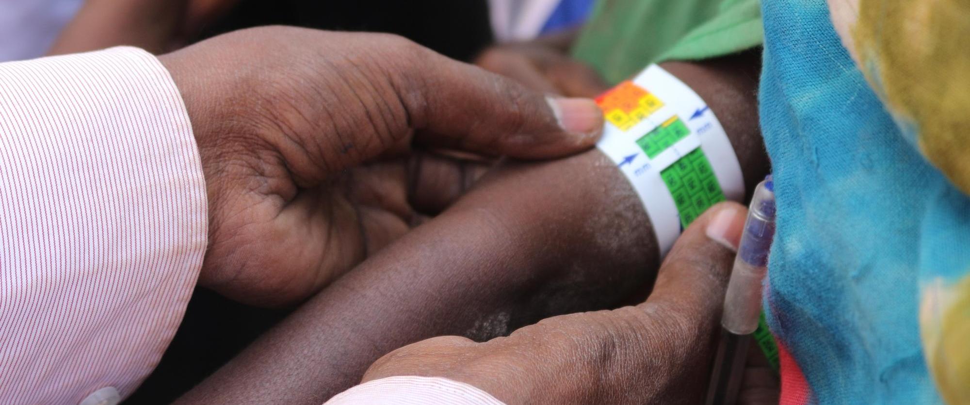 Un médecin mesure le poignet d'un enfant pour le dépistage de la malnutrition, à Asbuli, en Éthiopie. Février 2016. 